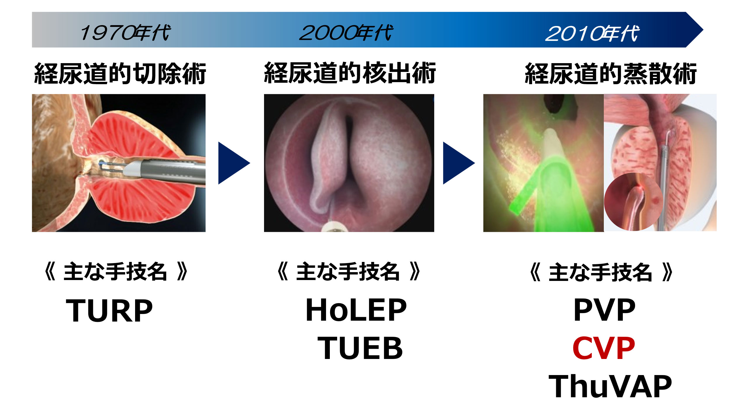 CVP（接触式レーザー前立腺蒸散術）