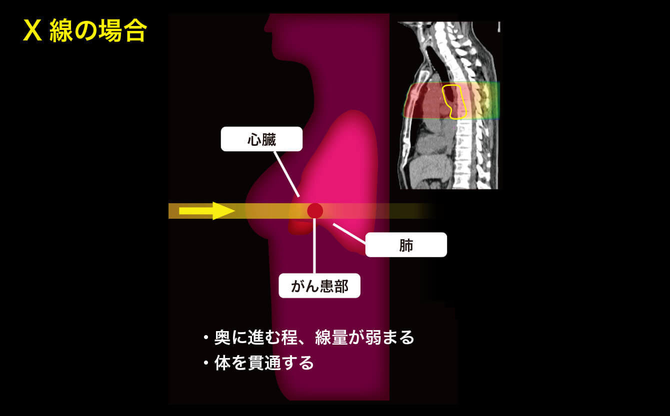 陽子線治療