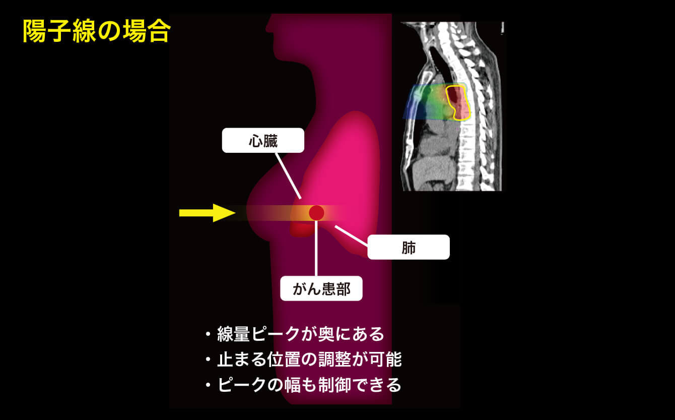 陽子線治療