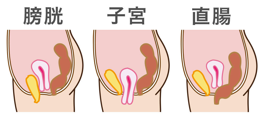 骨盤臓器脱