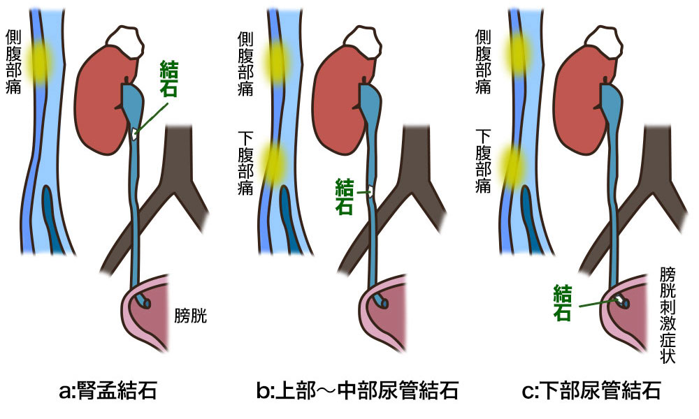 尿路結石