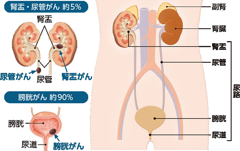 上部尿路上皮癌（腎盂・尿管がん）