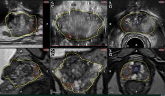 MRI-USフュージョン前立腺生検システムARIETTA 65 IntuitiveFusion